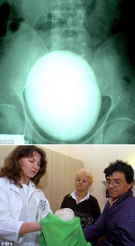 7-inch kidney stone x-ray