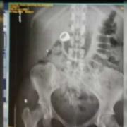 Swallowed diamond x-ray