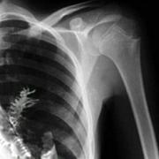 fir tree growing in man x-ray