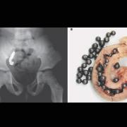 pellets in appendix x-ray