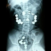 swallowed magnets x-ray