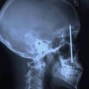 Nail lodged in skull x-ray